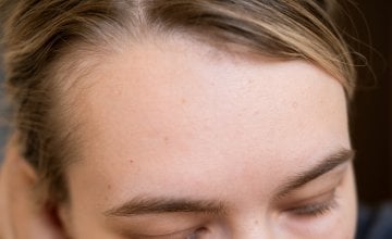 Polovica žena do 50. ima neki oblik gubitka kose