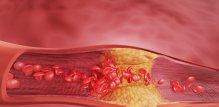 Previše kolesterola u krvi može tijekom vremena povećati rizik od srčanih bolesti, moždanog udara i drugih ozbiljnih komplikacija