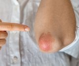 Psorijaza i prehrana