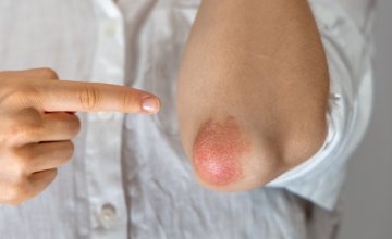 Psorijaza i prehrana