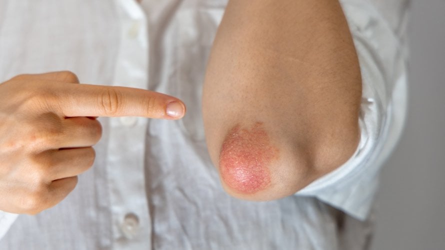 Psorijaza i prehrana