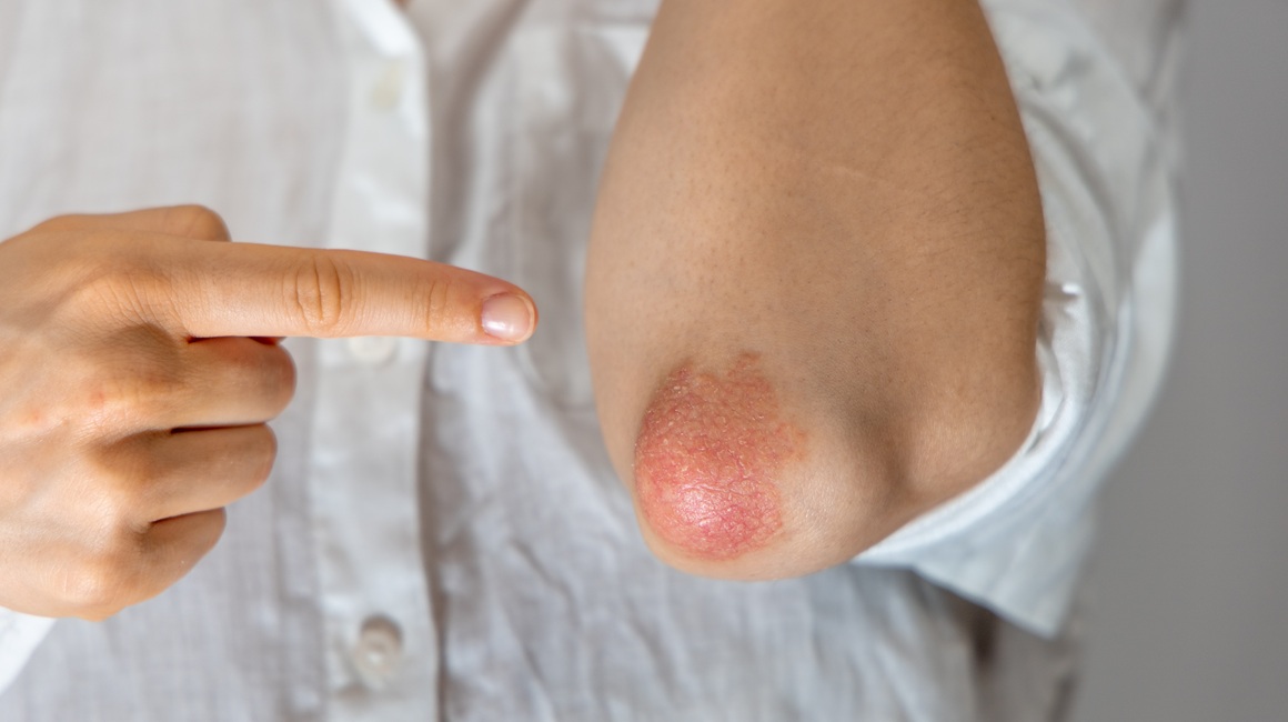 Psorijaza i prehrana