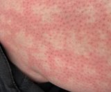 Sindrom opečene kože