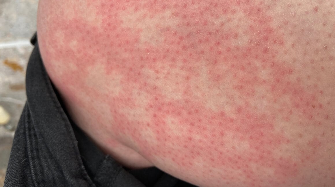 Sindrom opečene kože