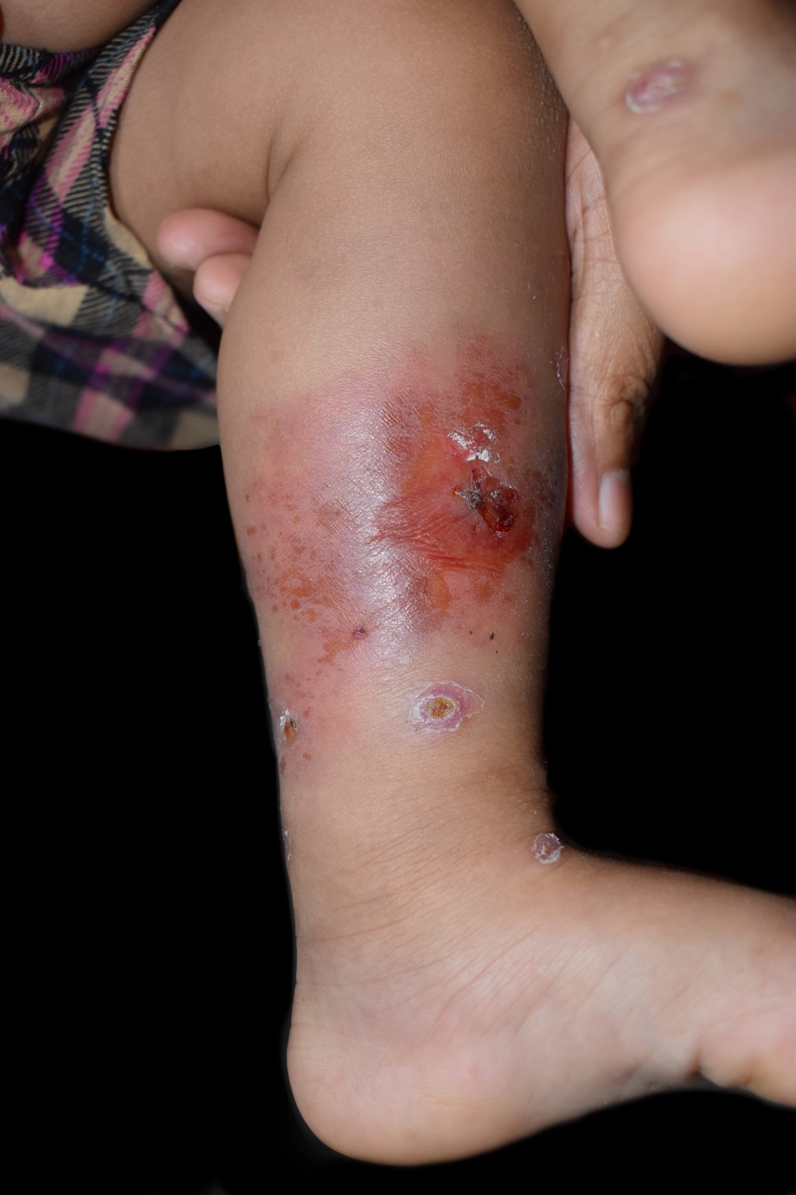 Stafilokok na koži kod beba