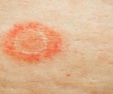 Stafilokok na koži - simptomi