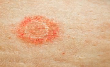 Stafilokok na koži - simptomi