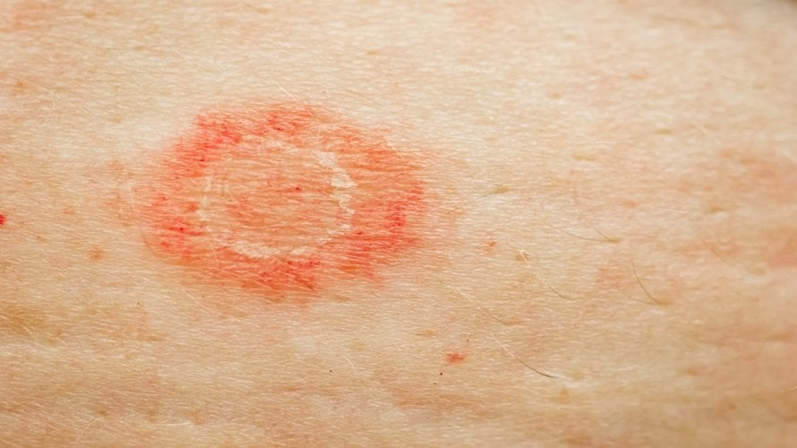 Stafilokok na koži - simptomi