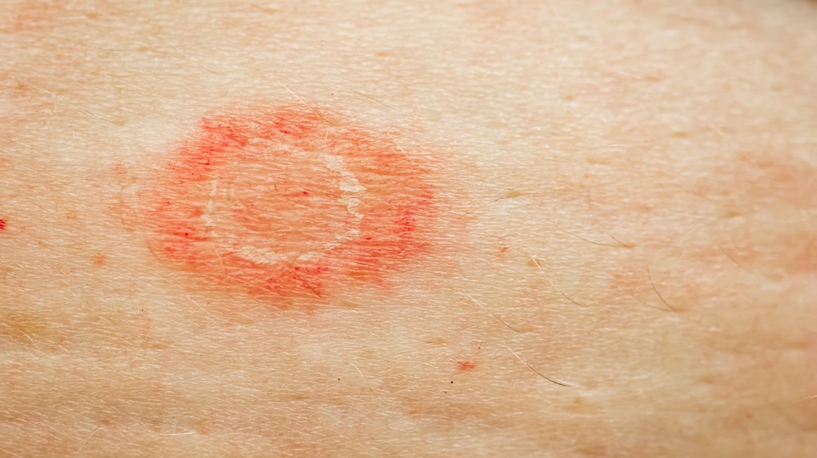 Stafilokok na koži - simptomi