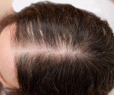 opadanje kose nakon mršavljenja