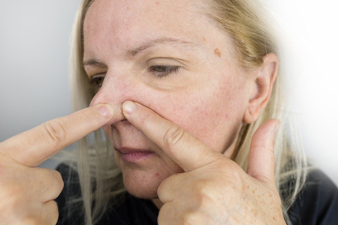 područje od uglova usana do korijena nosa - povezano je s povećanim rizikom od ozbiljnih infekcija koje mogu ugroziti vaše zdravlje