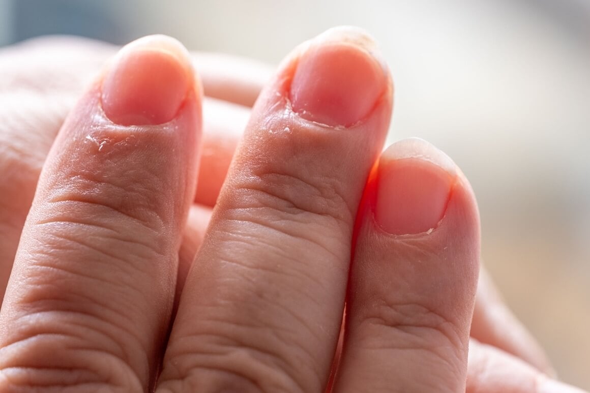 Dermatilomanija je poremećaj mentalnog zdravlja koji se očituje kao kompulzivno čupanje, grebanje ili stiskanje kože