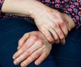 Dishidrotični ekcem