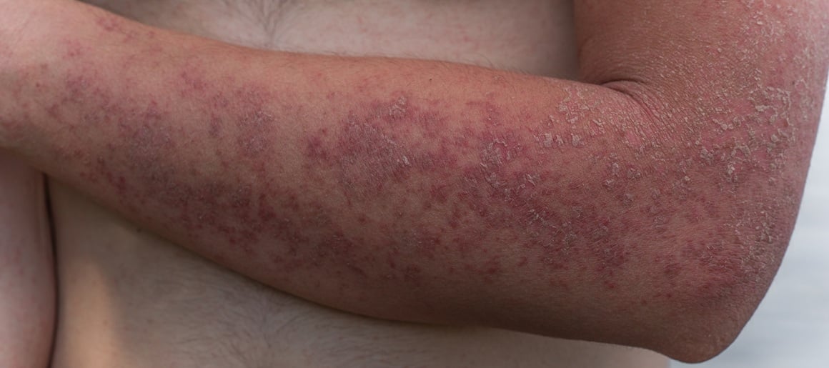 Dishidrotični ekcem - simptomi