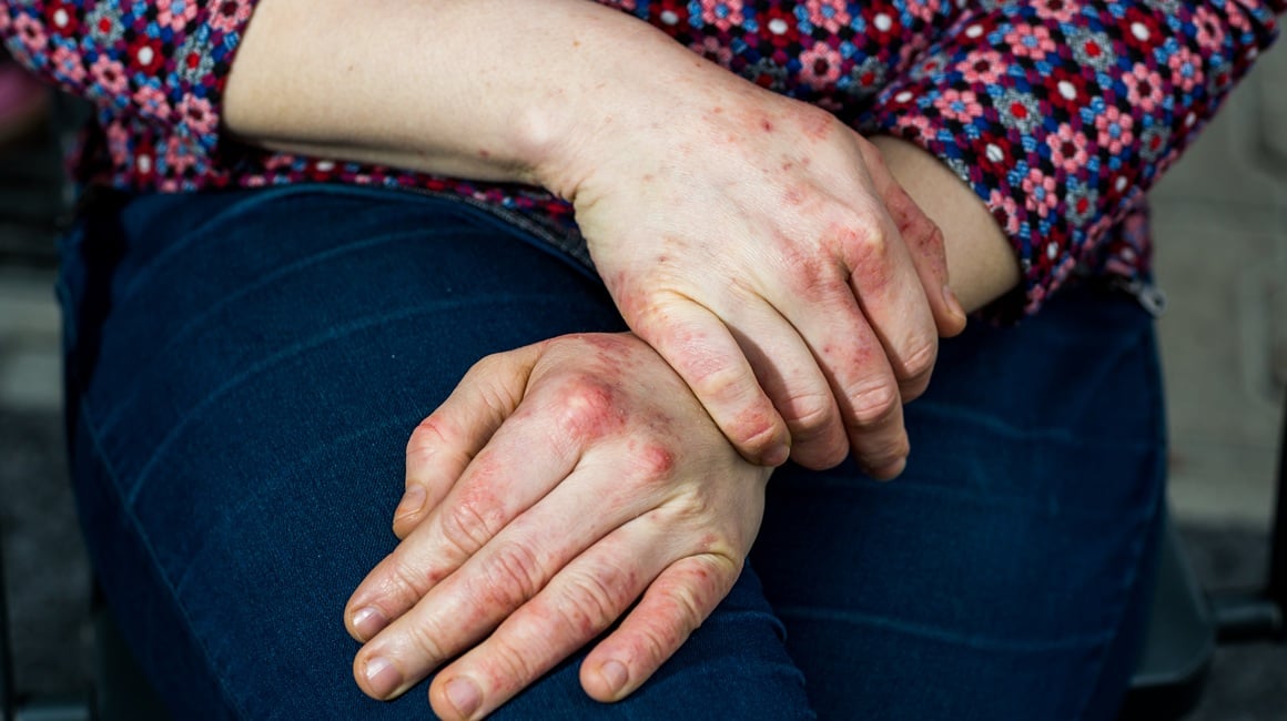 Dishidrotični ekcem