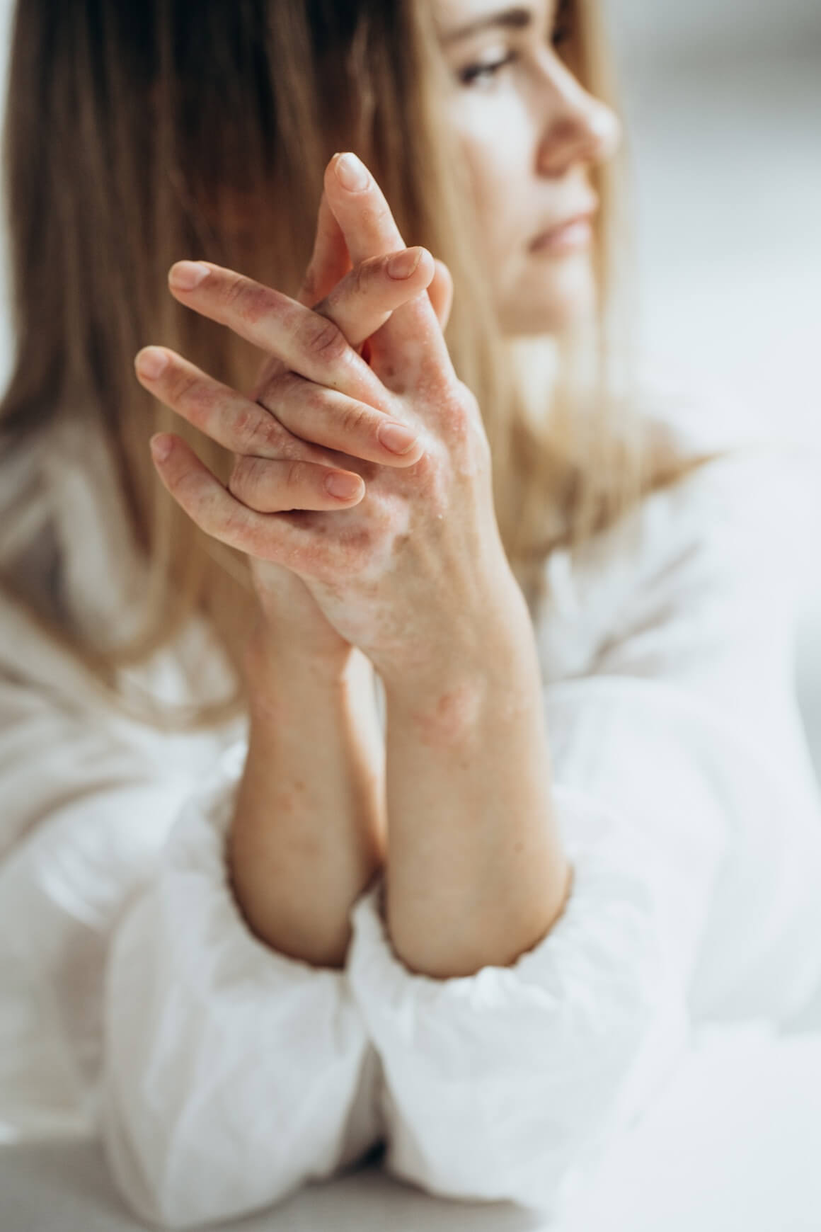 Komplikacije psorijaze kod žena