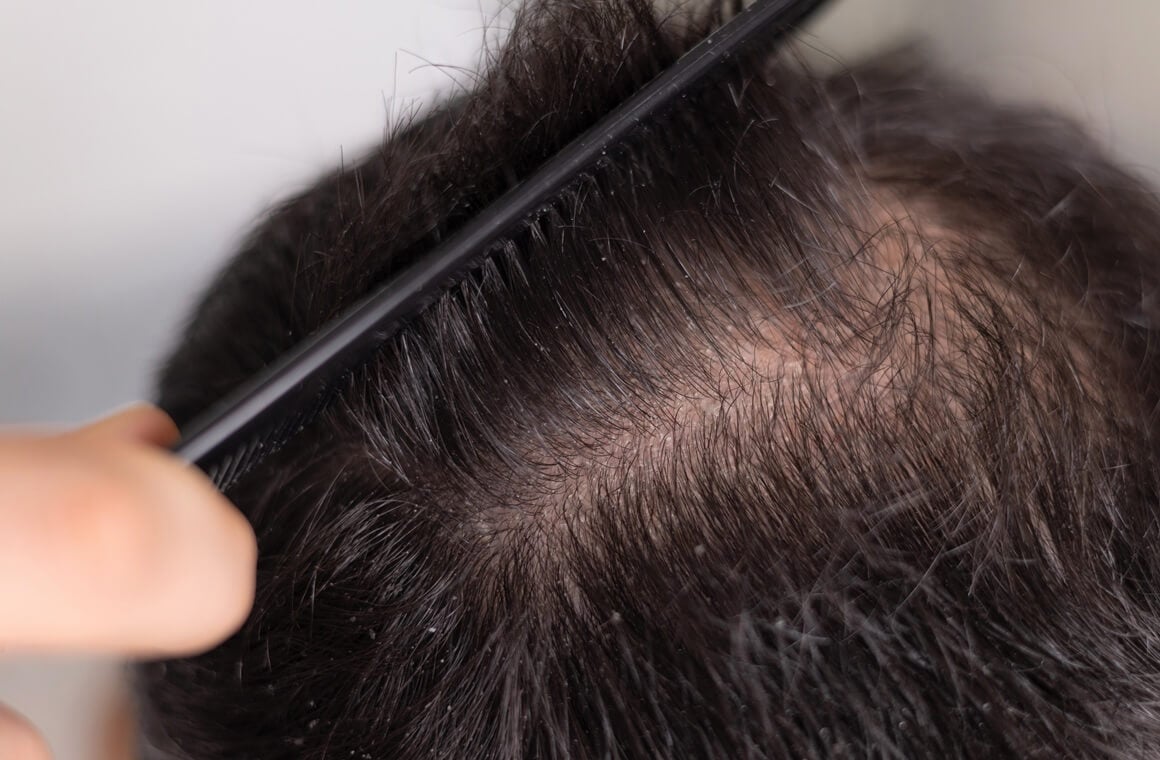 Kosa smrdi nakon pranja