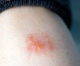 Kupanje i tuširanje često je izazov za osobe s ekcemom, budući da mnogi strahuju da bi svakodnevna higijena mogla izazvati pogoršanje simptoma