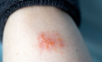 Kupanje i tuširanje često je izazov za osobe s ekcemom, budući da mnogi strahuju da bi svakodnevna higijena mogla izazvati pogoršanje simptoma