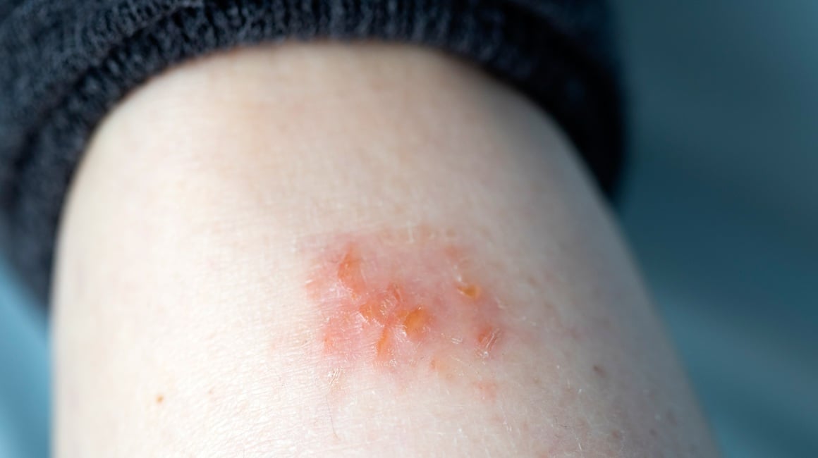 Kupanje i tuširanje često je izazov za osobe s ekcemom, budući da mnogi strahuju da bi svakodnevna higijena mogla izazvati pogoršanje simptoma