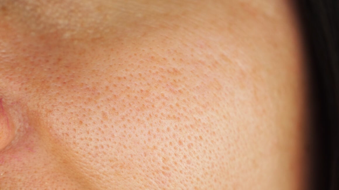 Masna koža ima veće pore i deblji sloj kože, što pruža dodatni jastučić i ublažava pojavu tankih bora