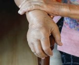 Nedostatak proteina u organizmu