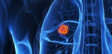 Rak pluća i dalje je jedan od najčešćih uzroka smrti od raka