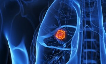 Rak pluća i dalje je jedan od najčešćih uzroka smrti od raka