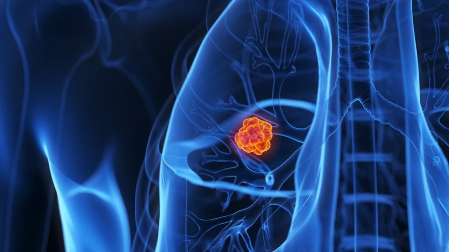 Rak pluća i dalje je jedan od najčešćih uzroka smrti od raka