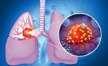 Rak pluća i dalje je jedan od najsmrtonosnijih oblika raka