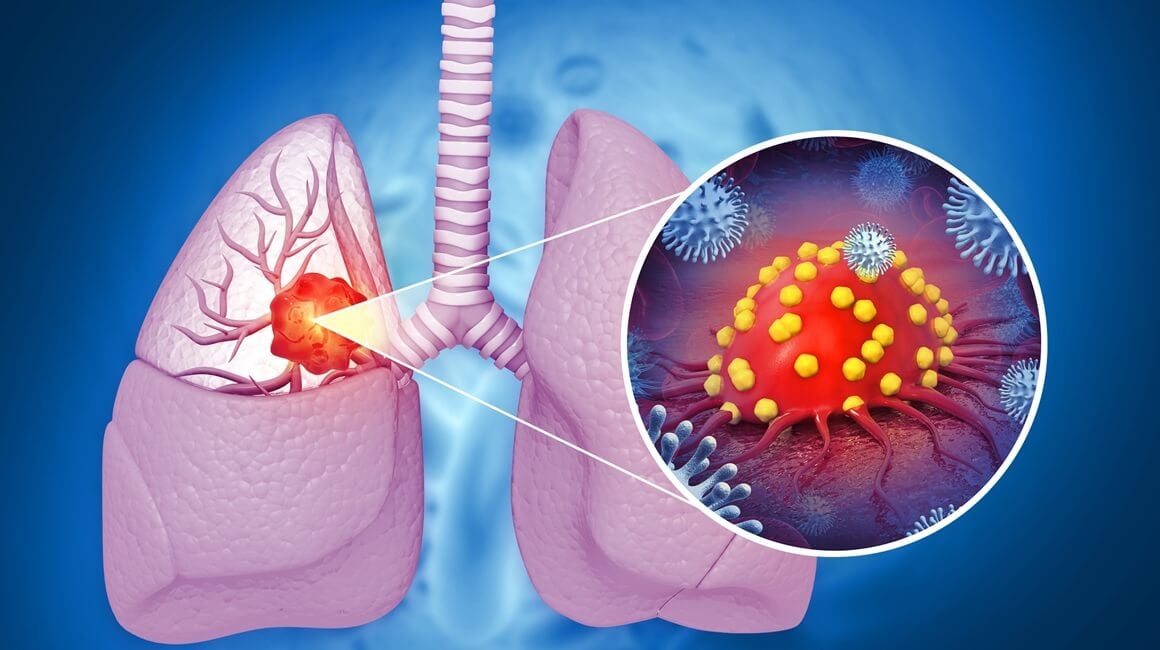 Rak pluća i dalje je jedan od najsmrtonosnijih oblika raka