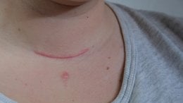 Rak štitnjače često je bolest s odličnom prognozom