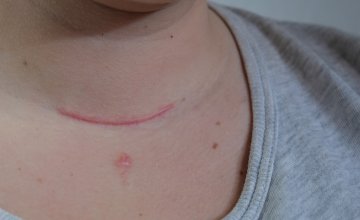 Rak štitnjače često je bolest s odličnom prognozom