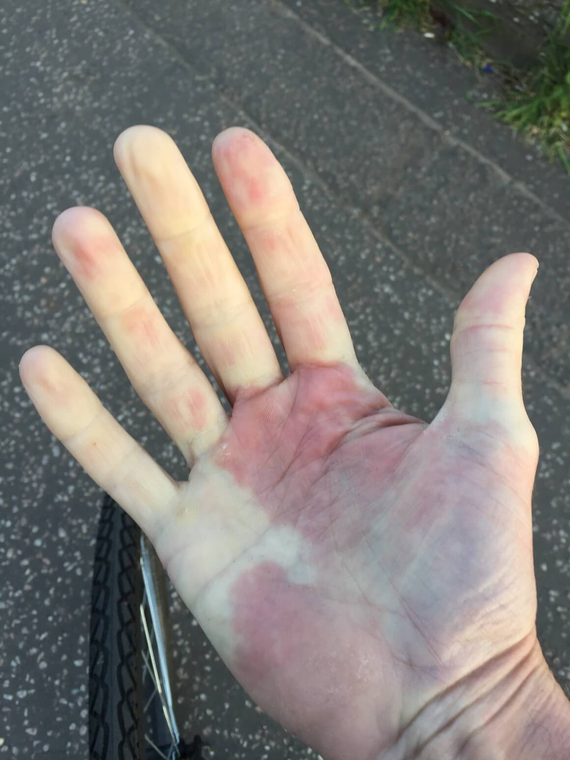 Raynaudova bolest uzrokuje prekomjerno sužavanje krvnih žila u prstima ruku i nogu pri izlaganju hladnoći