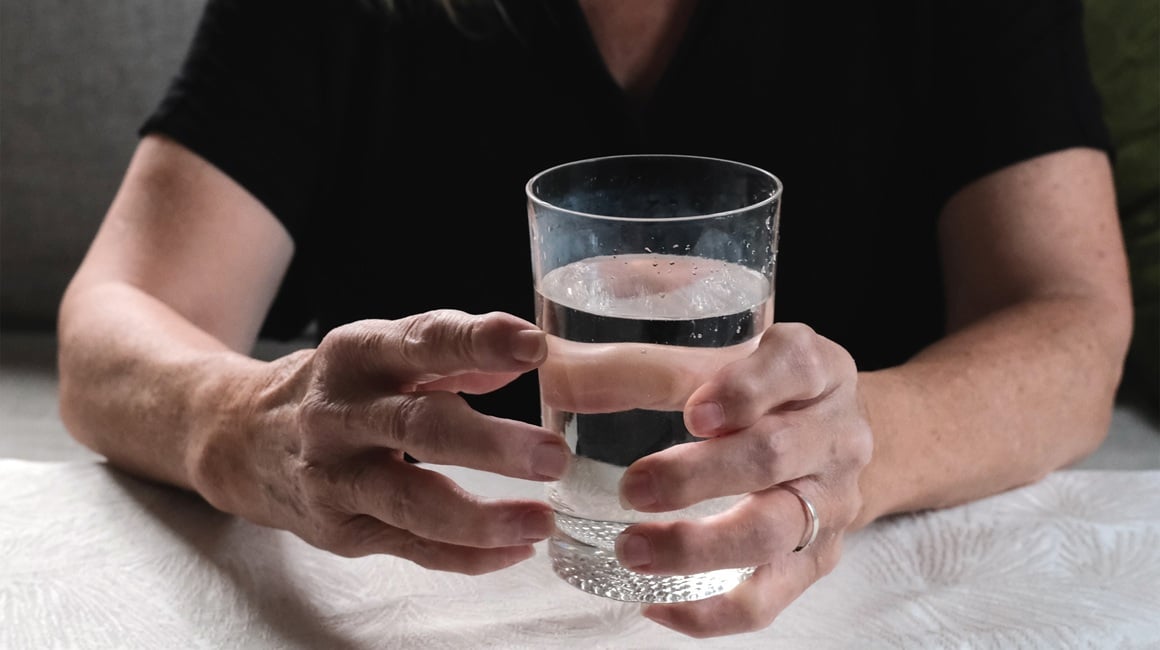 Reumatoidni artritis je kronična autoimuna bolest kod koje imunološki sustav napada vlastite zglobove, uzrokujući upalu, bol i ukočenost