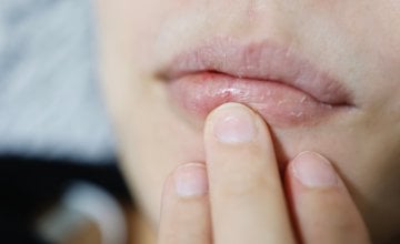 Suha usta mogu biti mnogo više od neugodne tegobe - često su znak da vašem tijelu nešto nedostaje