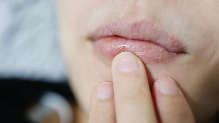 Suha usta mogu biti mnogo više od neugodne tegobe - često su znak da vašem tijelu nešto nedostaje