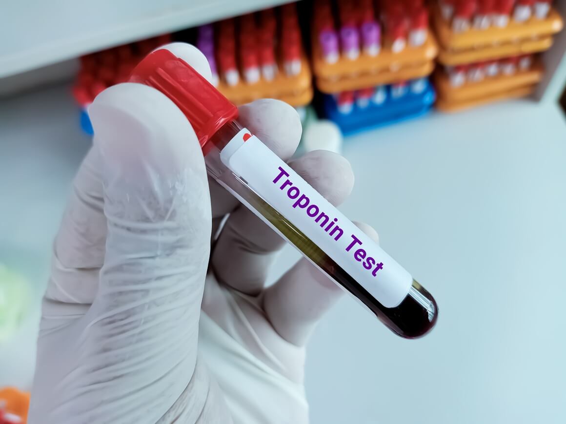 Troponin je protein koji se nalazi u stanicama srčanog mišića i koji se otpušta u krv kad srce pretrpi oštećenje