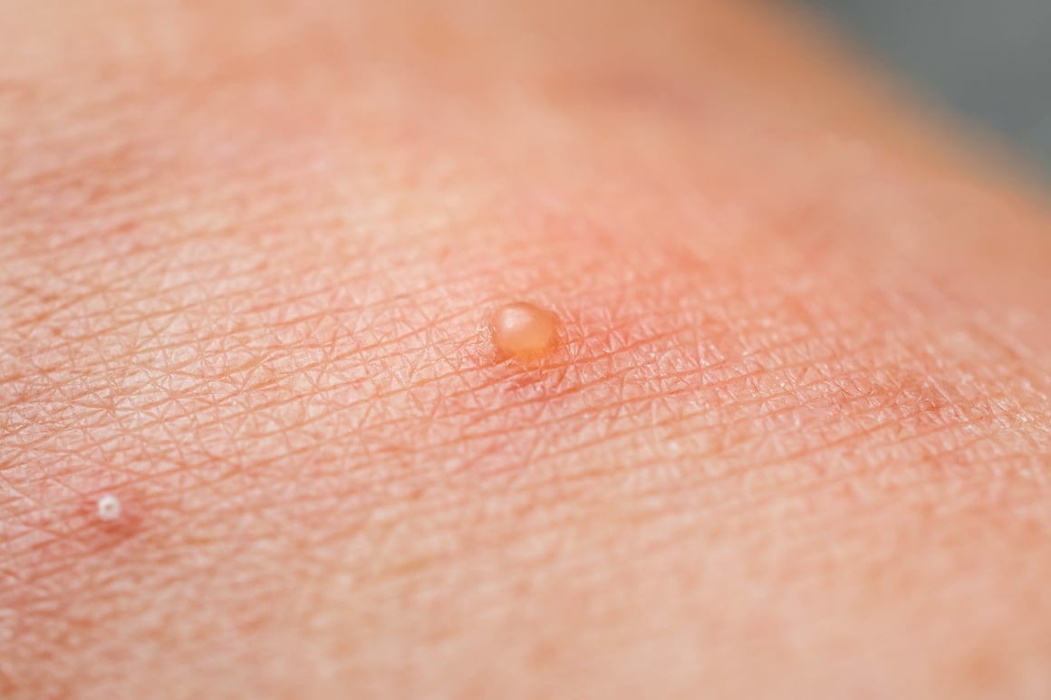 dishidrotični dermatitis