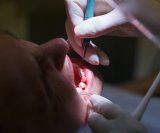 liječenje korijenskog kanala može poboljšati razinu šećera u krvi, kolesterol i smanjiti upalne procese u tijelu