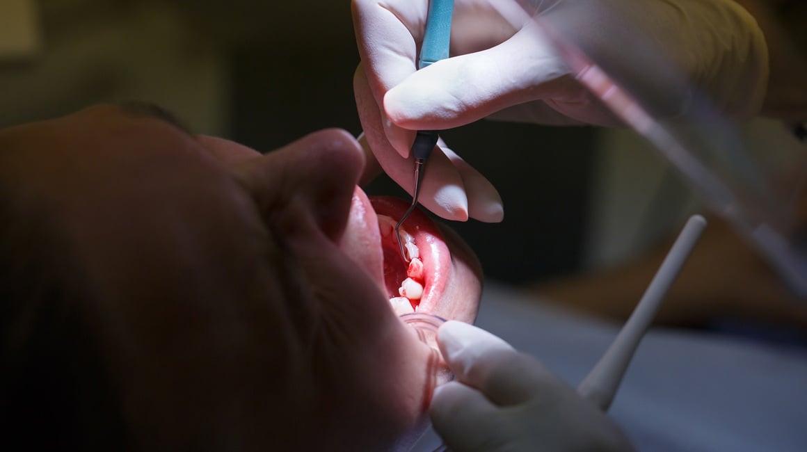 liječenje korijenskog kanala može poboljšati razinu šećera u krvi, kolesterol i smanjiti upalne procese u tijelu