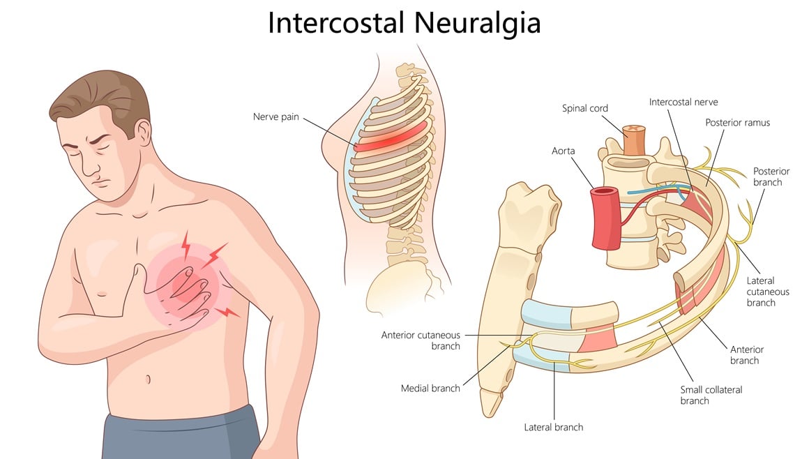 međurebrena neuralgija
