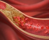 nezdrava veganska prehrana može povećati razinu kolesterola u krvi