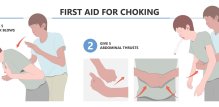 prva pomoć kod gušenja