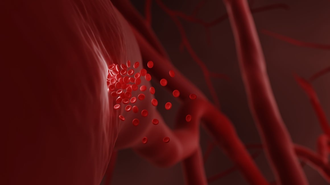 teška konzumacija alkohola povećava rizik od ranijeg i opasnijeg moždanog udara