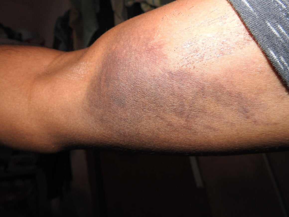 Duboka venska tromboza (DVT) može nastati i na rukama, iako je rjeđa nego u nogama