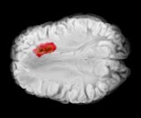 Glioblastom je izuzetno agresivan tumor s vrlo lošom prognozom