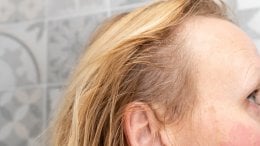 Gubitak kose može biti iznenađujuća i neugodno vidljiva nuspojava nekih lijekova za artritis