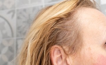 Gubitak kose može biti iznenađujuća i neugodno vidljiva nuspojava nekih lijekova za artritis