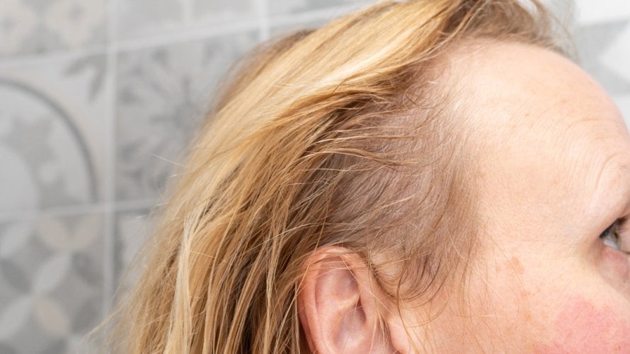 Gubitak kose može biti iznenađujuća i neugodno vidljiva nuspojava nekih lijekova za artritis